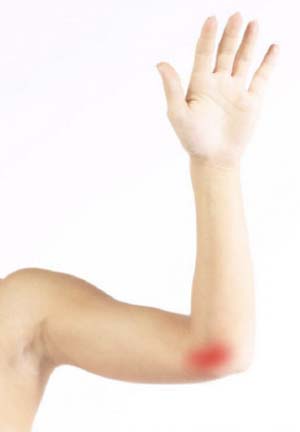 Cubital Tunnel Syndrome  Advanced Hand, Wrist & Nerve Centre