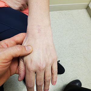 One case of wrist cyst rupture with nerve and blood vessel